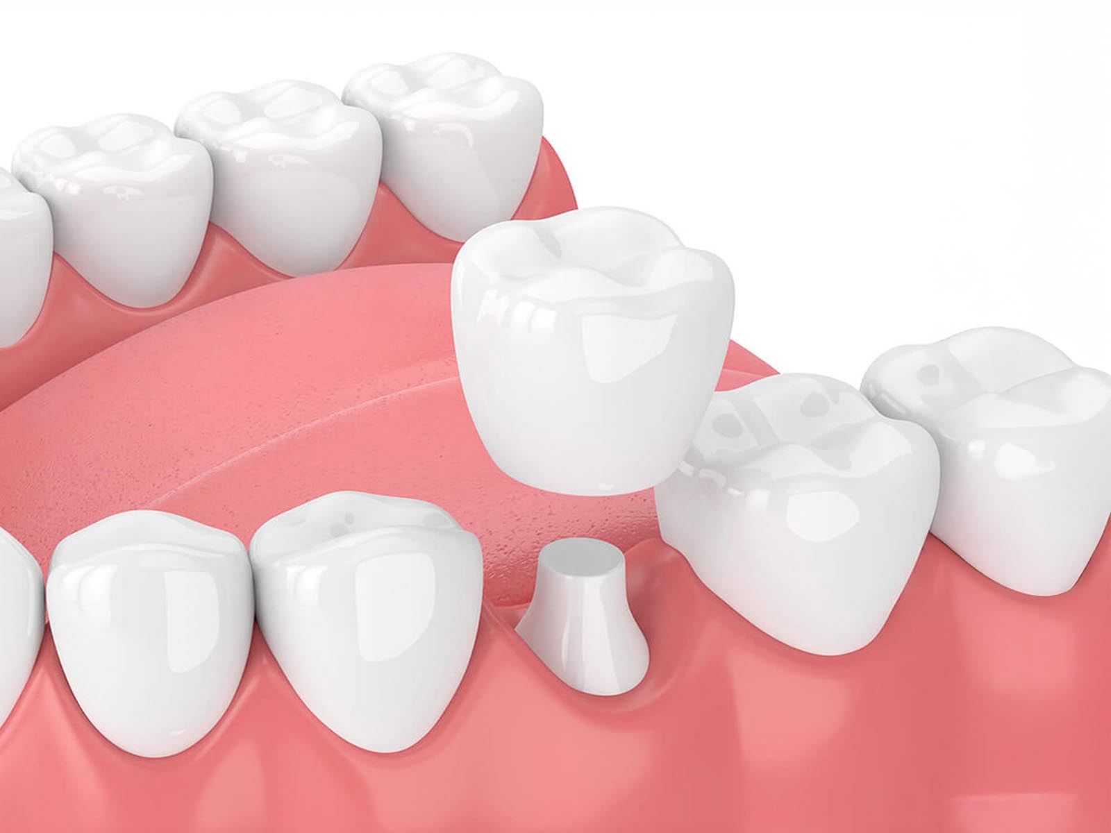 Dental Crowns and Bridges Services